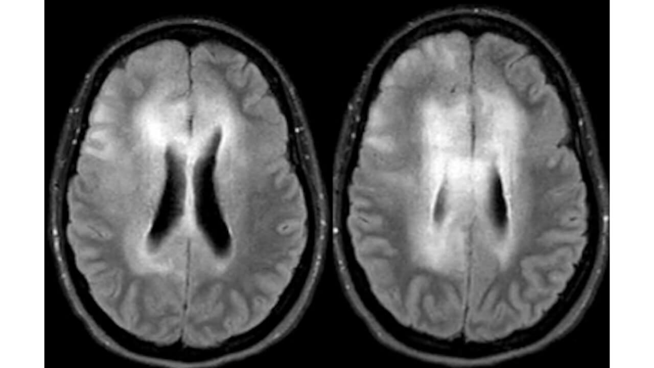 Imagine of Brain MRI Flair GAD Axial