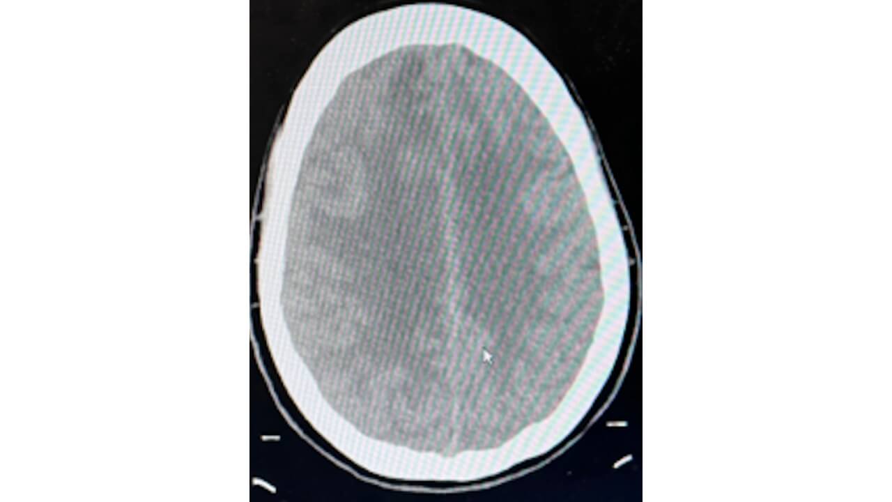 Photo of CT Head Axial