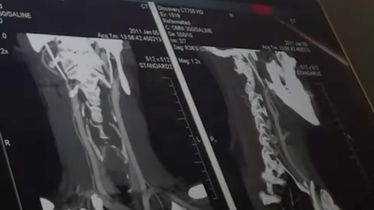 Image of an x-ray of a head and neck, plays video