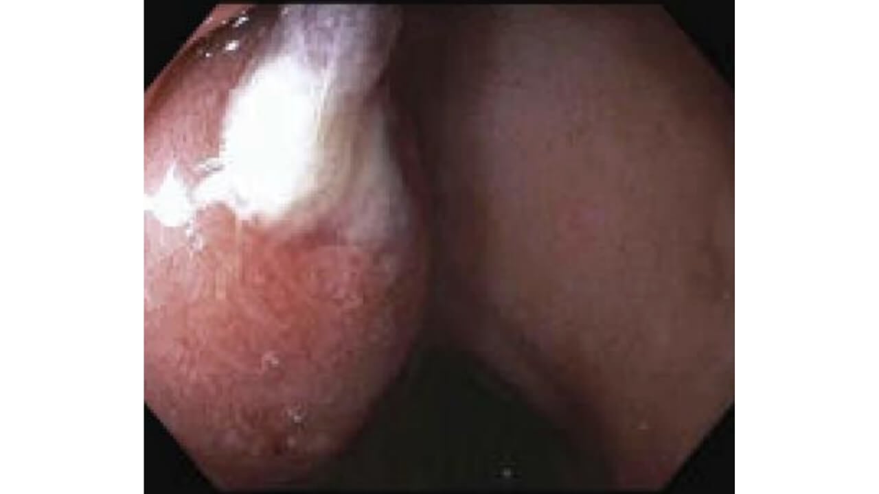 Photo of emergent EGD showing friable mucosa and edematous anterior duodenal bulb tissue