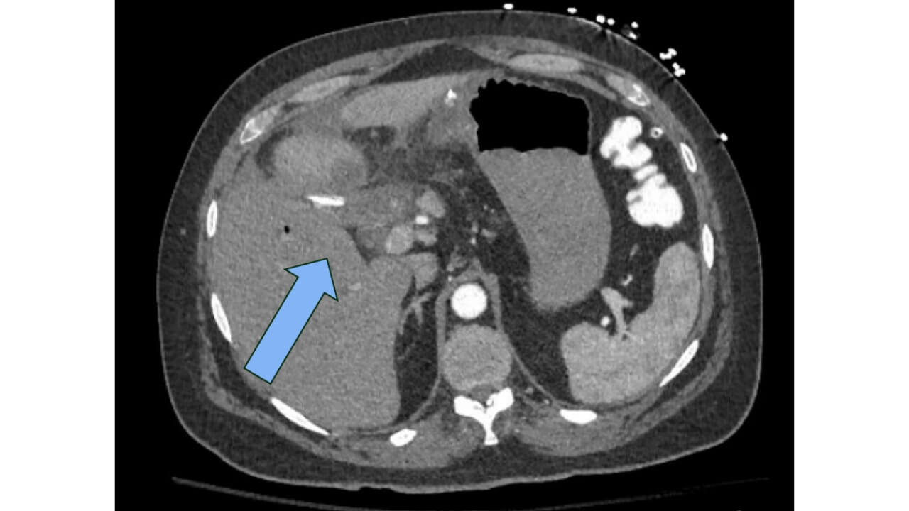 Photo of emergent CTA Abdomen/Pelvis showing filling defect and occlusion of right hepatic artery