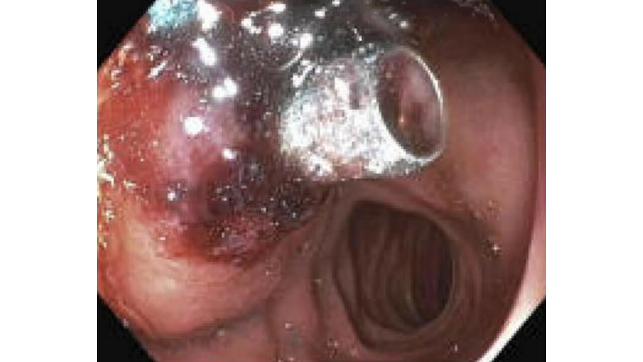 Photo showing subsequent management of bleed with application of hemoclips and hemostatic agent