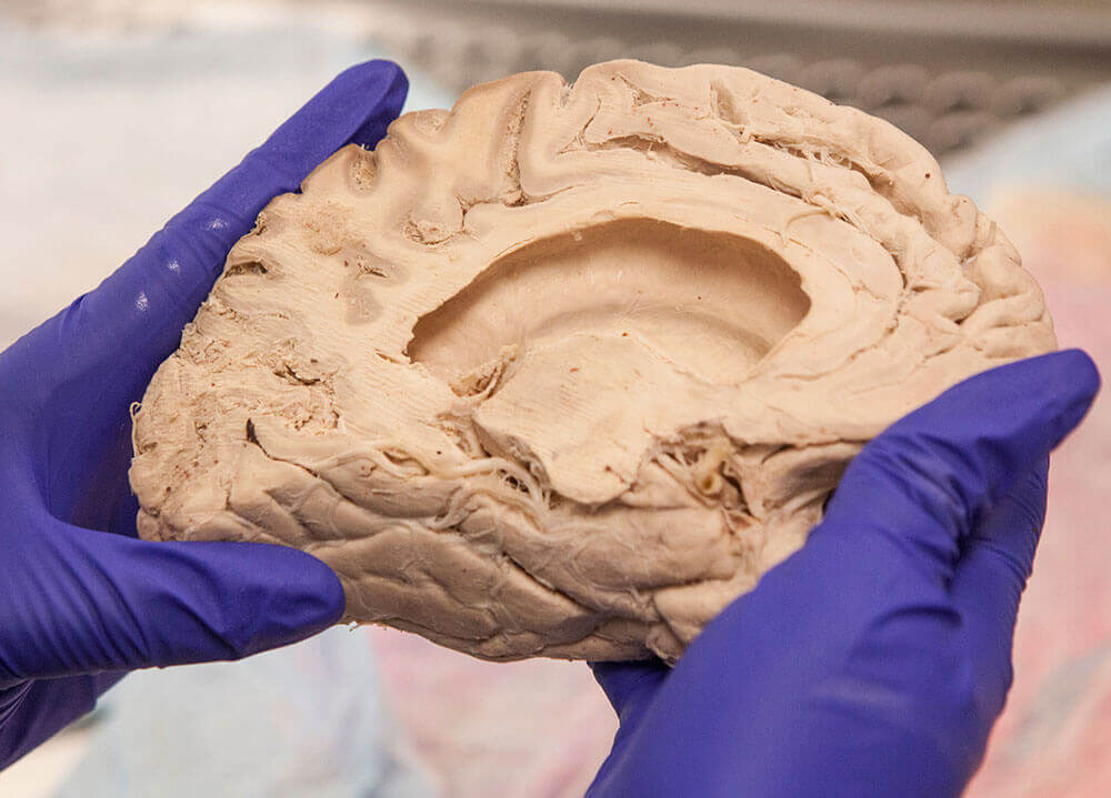 A pair of gloved hands hold the cross section of a human brain.
